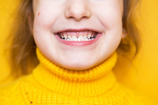 La niña muestra su mordida patológica de los dientes, maloclusión, sobremordida. Odontopediatría y periodoncia, corrección de mordida. Salud y cuidado de los dientes, tratamiento de caries, dientes de leche. La mandíbula superior descansa sobre la encía.