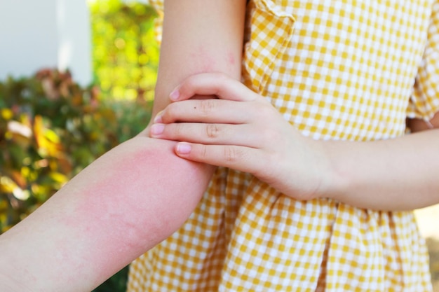 Foto la niña tiene alergia a la erupción cutánea y picazón en el brazo