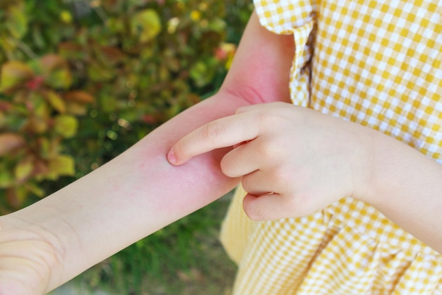 La niña tiene alergia a la erupción cutánea y picazón en el brazo