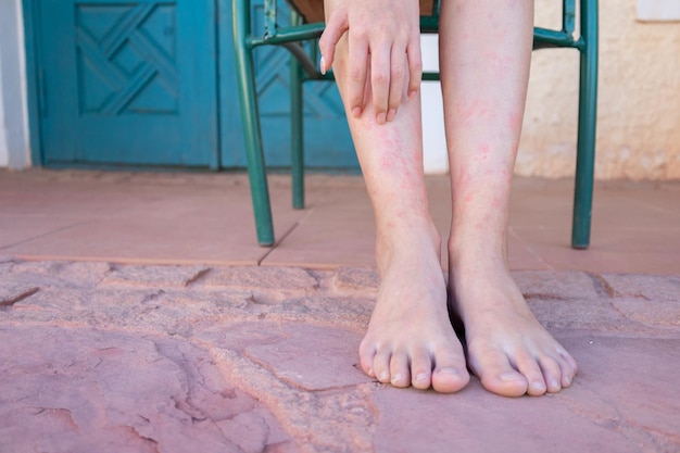 Foto niñas piernas mordidas por mosquitos de primer plano mujer rascándose los pies mordidas por insectos