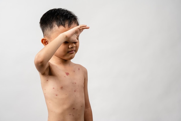 Foto un niño asiático de 7 años tiene granos de varicela en el cuerpo de un niño con varicela