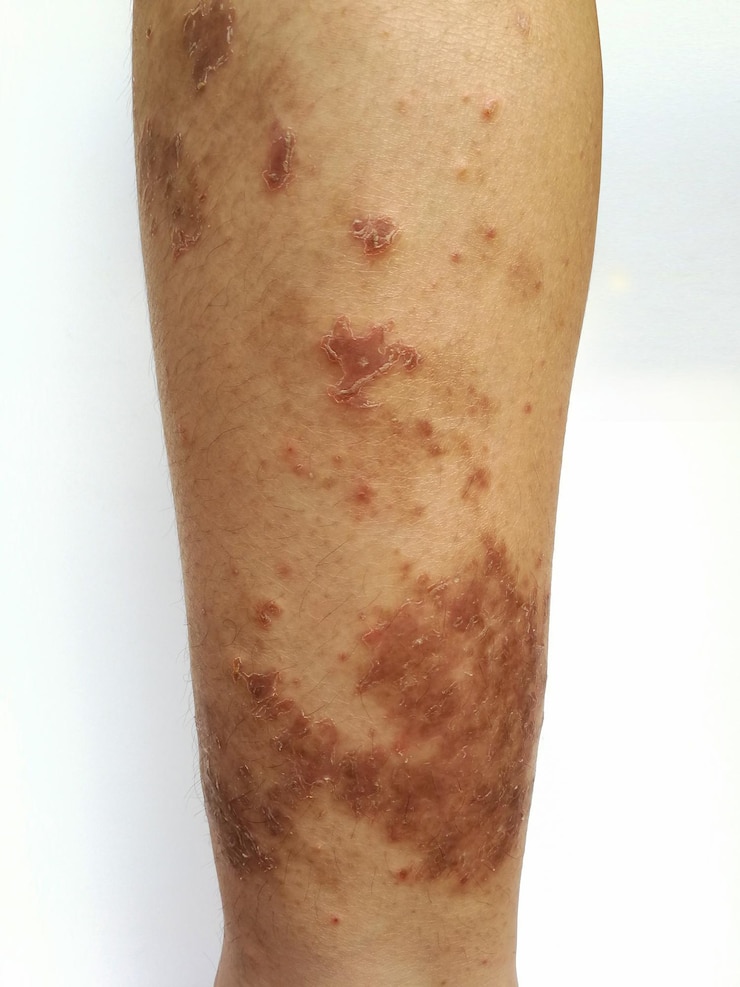Niño joven tiene erupción cutánea crónica enfermedad cutánea alérgica a la hierba dermatitis atópica manchas cutáneas por edad
