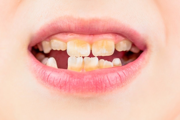 Niño con mala dentadura. Retrato de niño con mala dentadura. El niño sonríe y muestra su apiñamiento de dientes. Cerca de los dientes de leche malsanos. Paciente niño boca abierta mostrando caries dientes caries.