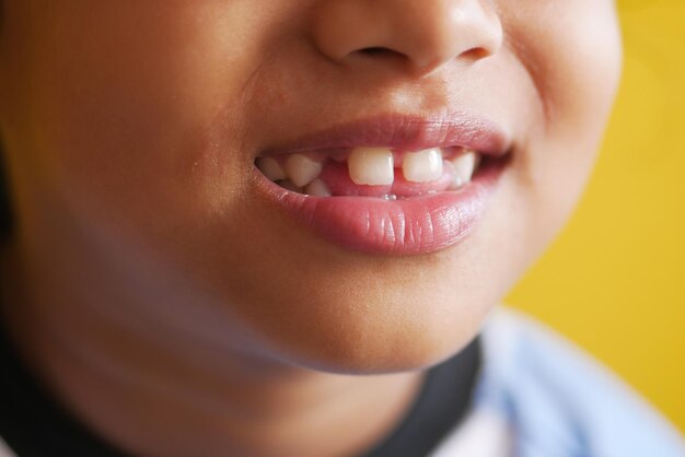 Niño niña con dientes deformados