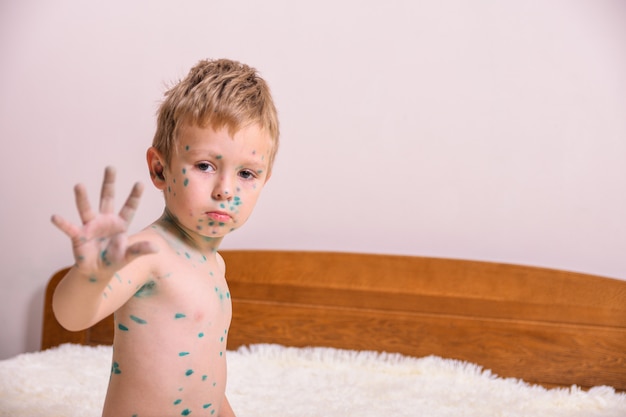 Niño pequeño, muchacho con varicela. Niño enfermo con varicela. Virus de la varicela o erupción de la varicela en el cuerpo y la cara del niño.