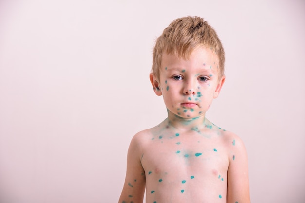 Niño pequeño con varicela. Niño enfermo con varicela. Virus de la varicela o erupción de la varicela en el cuerpo y la cara del niño. Retrato de niño con viruela.