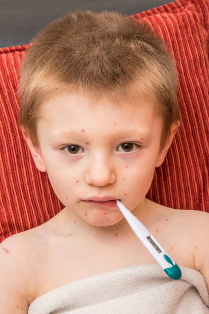 Niño con varicela que mide la fiebre