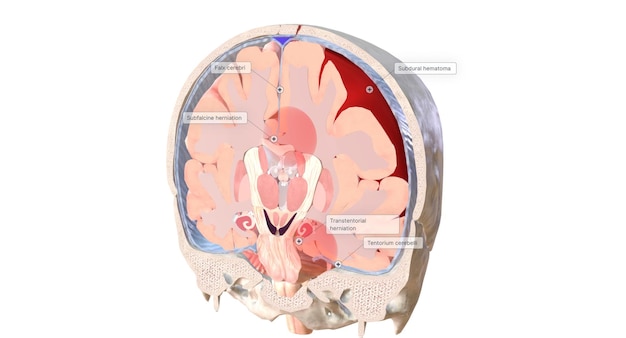 Foto o aumento da pressão de hematomas subdurais pode levar a deslocamentos de tecido no cérebro herniações cerebrais