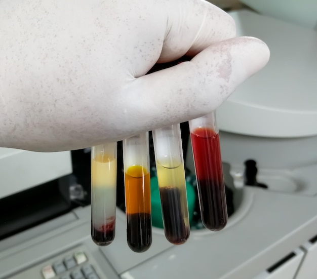 Foto o bioquímico guarda diferentes tipos de amostras de sangue que podem interferir no valor do teste bioquímico