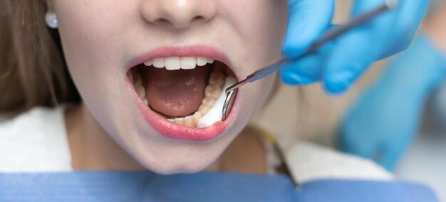 O dentista coloca um cotonete nas bochechas do paciente com a boca aberta. Conceito de tratamento odontológico e prevenção de cárie