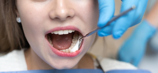 O dentista coloca um cotonete nas bochechas do paciente com a boca aberta. Conceito de tratamento odontológico e prevenção de cárie