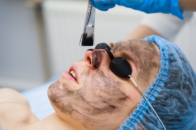 O dermatologista passa máscara preta no rosto para fotorejuvenescimento a laser e peeling de carbono. dermatologia e cosmetologia. usando laser cirúrgico.