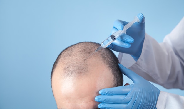 O médico faz a injeção na cabeça do homem para o crescimento do cabelo.