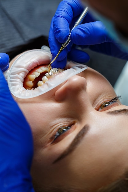 O ortodontista coloca aparelhos de metal nos dentes do paciente. Tratamento odontológico ortodôntico. Foto de alta qualidade