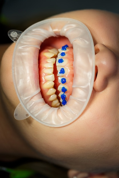 O ortodontista coloca aparelhos de metal nos dentes do paciente. tratamento odontológico ortodôntico. foto de alta qualidade