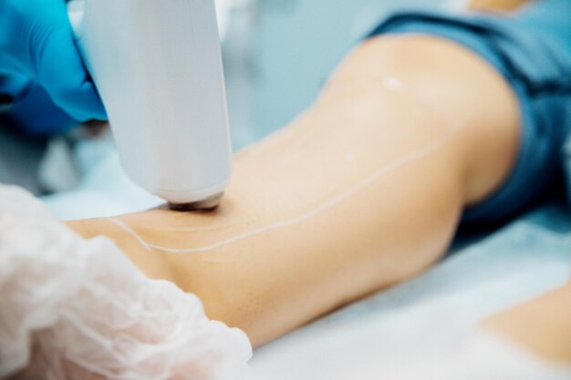 O procedimento de depilação a laser nas pernas das mulheres. aplicação de pasta de açúcar para o processo de adoçamento.