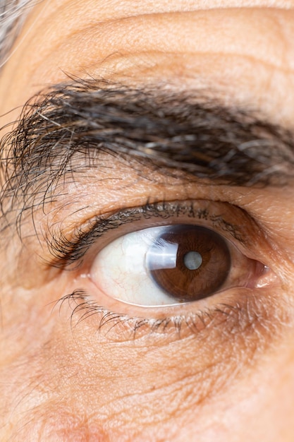 Ojo de un anciano con cataratas