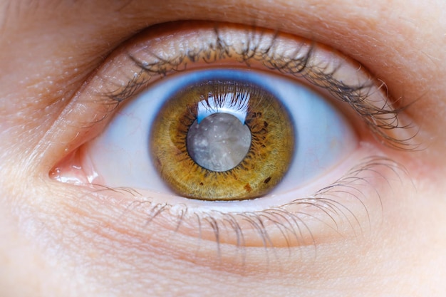 Ojo humano con lente nublada, pupila blanca, macro de cataratas.