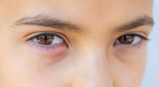 El ojo del niño está inflamado Enfoque selectivo