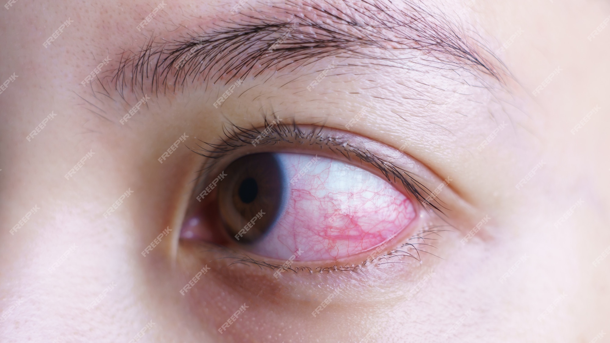 Olhos Irritados De Uma Menina Que Ficasse Doente Com Conjuntivite Foto de  Stock - Imagem de adolescente, inchado: 146506816