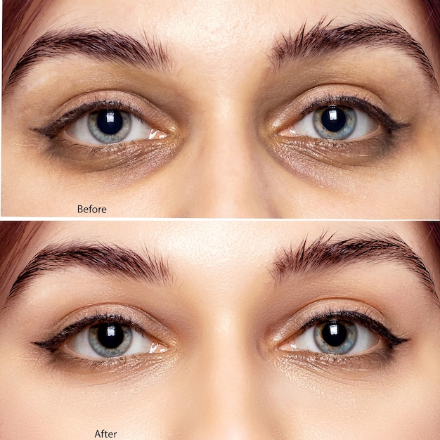 Olhos da mulher antes e depois dos procedimentos Problemas de pele e sua solução