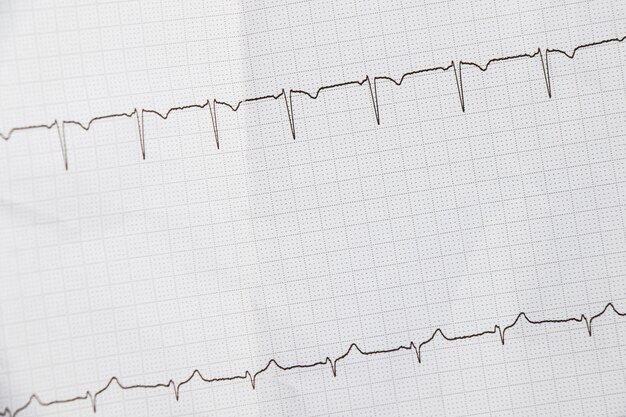 Foto ondas de cardiograma del latido del corazón ekg en el papel arritmia