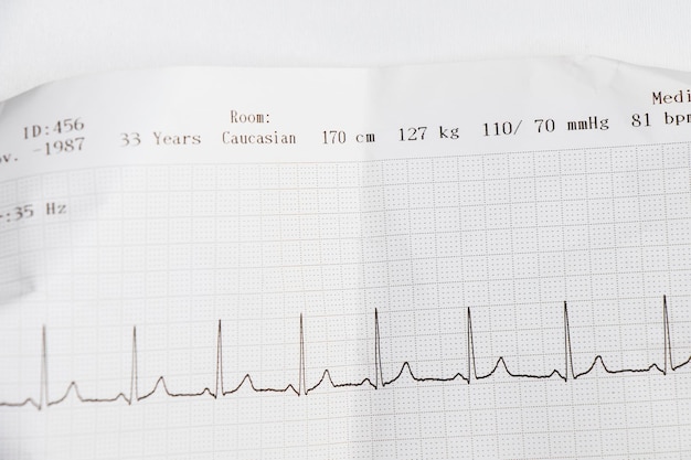 Ondas de cardiograma del latido del corazón EKG en el papel