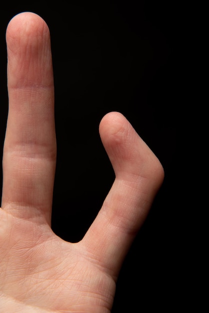 Orthopädische Medizin Vorderansicht der gebrochenen und deformierten Außenbandverletzung des kleinen Fingers