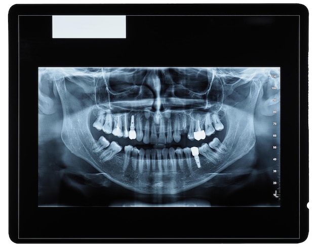 Foto ortopantomografía radiografía de imagen panorámica de los dientes