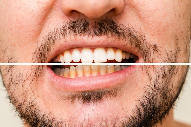 Foto os dentes do homem antes e depois do branqueamento e dos aparelhos ortopédicos