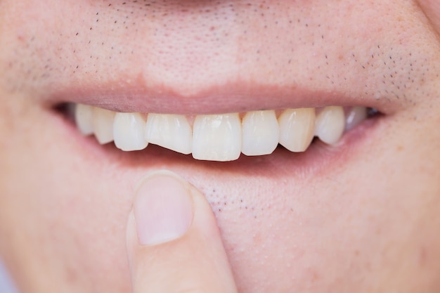 Foto os dentes quebrados masculinos danificaram o dentista dianteiro rachado da necessidade do dente para fixar e reparar.