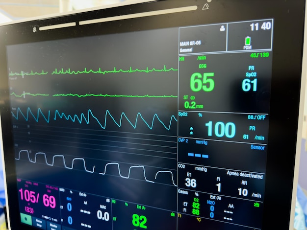 Foto os monitores do hospital mostram sinais vitais, hemodinâmica, frequência cardíaca, pressão arterial, temperatura, oxigénio.