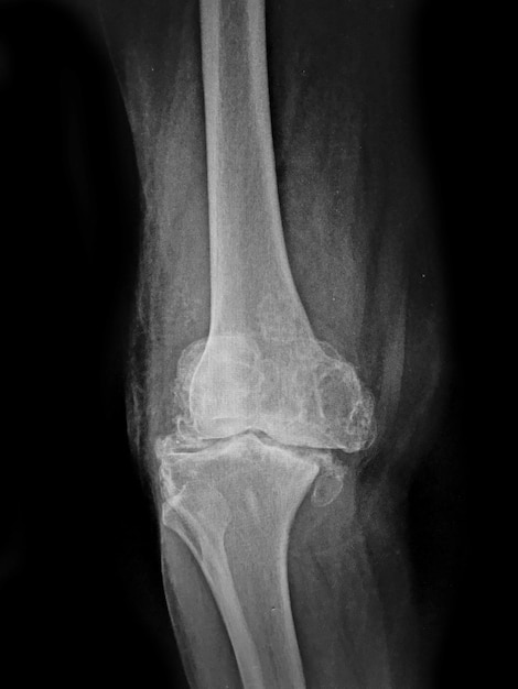 Foto osteoartritis de la rodilla película de rayos x ap anterior posterior