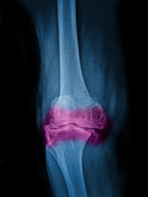 Osteoartritis de la rodilla película de rayos X AP anterior posterior