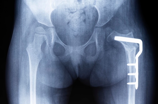 Osteotomía de la articulación de la cadera La radiografía de la pelvis muestra displasia de la placa de metal del muslo izquierdo