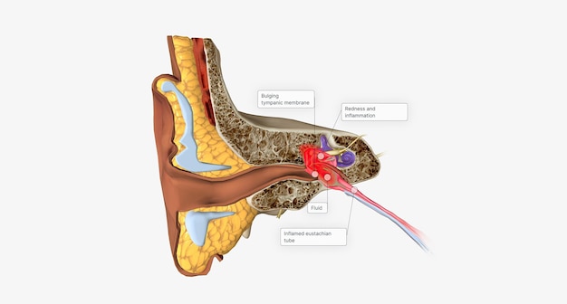 Foto la otitis media aguda es una infección e inflamación del oído medio, generalmente con líquido detrás de la membrana timpánica.