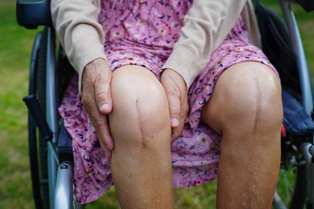 Paciente anciana asiática con cirugía de reemplazo de rodilla con cicatriz en el hospital