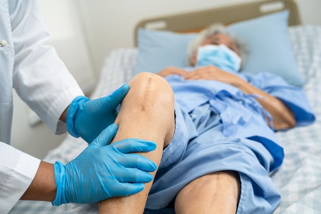 Paciente asiática sênior mostra suas cicatrizes Substituição cirúrgica total da articulação do joelho