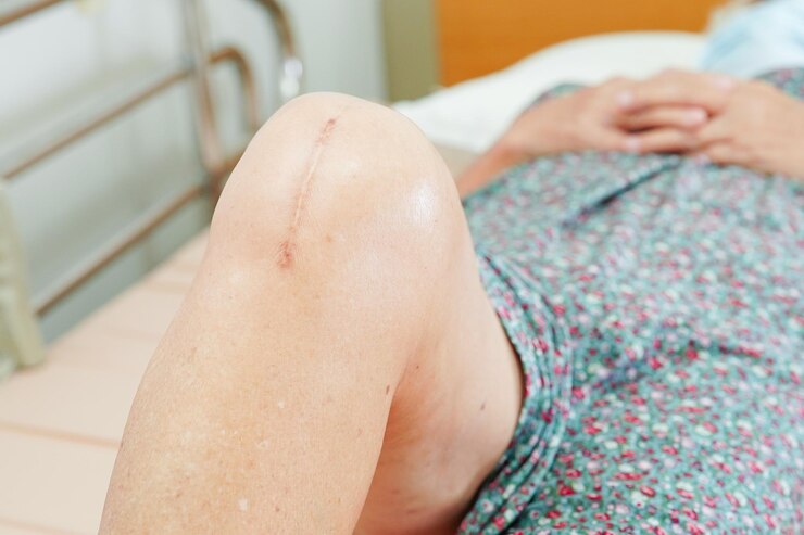Foto paciente idosa asiática com cirurgia de substituição do joelho de cicatriz no hospital