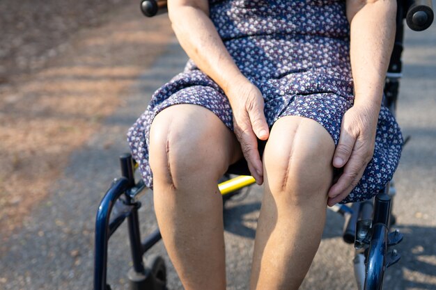 Foto paciente mujer mayor asiática muestra sus cicatrices quirúrgico reemplazo total de la articulación de la rodilla