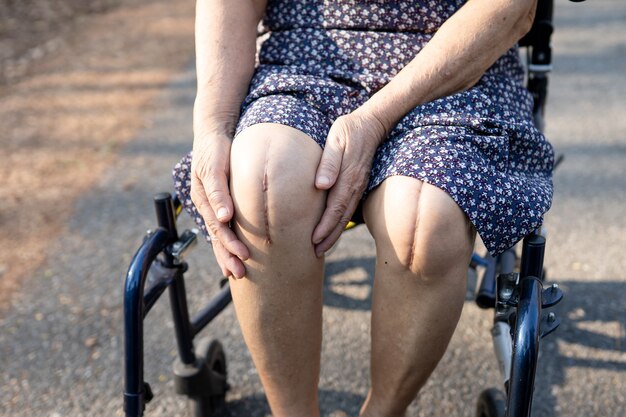 Foto paciente mujer mayor asiática muestra sus cicatrices quirúrgico reemplazo total de rodilla