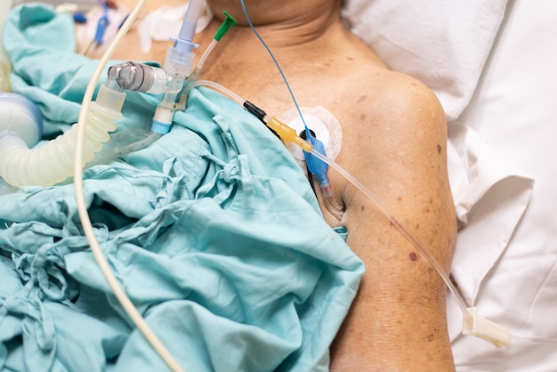 Paciente mulher idosa asiática covid fazer traqueostomia usar ventilador
