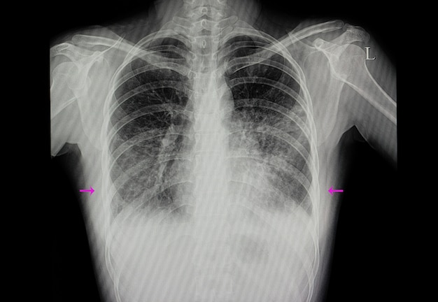 Paciente con neumonía en ambos pulmones.