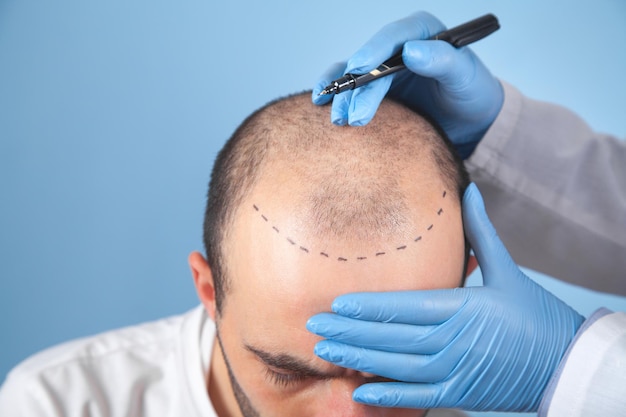 Paciente que sufre de pérdida de cabello en consulta con un médico