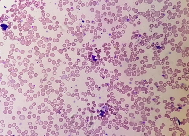 Foto pancitopenia. una afección en la que hay una menor cantidad de glóbulos rojos, glóbulos blancos y plaquetas en la sangre.