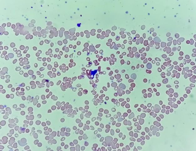 Pancitopenia. Una afección en la que hay una menor cantidad de glóbulos rojos, glóbulos blancos y plaquetas en la sangre.