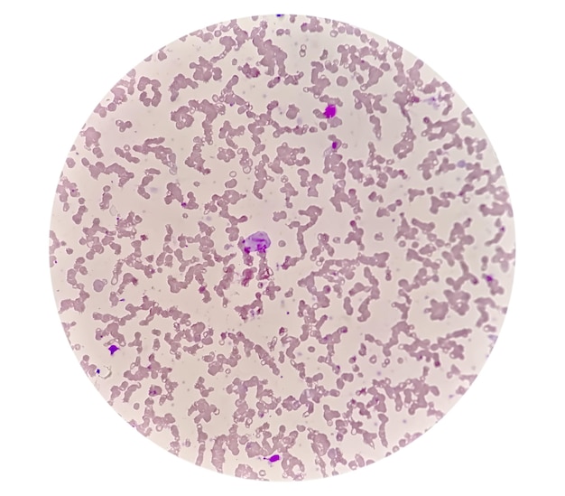 Pancitopenia. Uma condição na qual há um número menor de hemácias, glóbulos brancos e plaquetas no sangue.