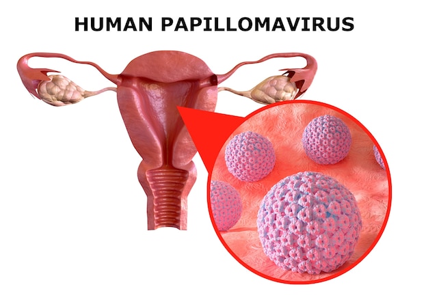 Foto papilomavírus humano ou hpv, infecção sexualmente transmissível.