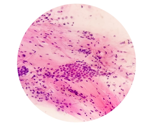 PAPS-Abstrichstudie einer jungen Frau unter Mikroskopie, die atrophische Veränderungen im Uterus zeigt