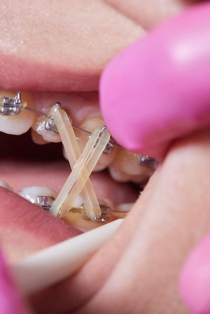 Foto parentescos de perto em dentes com elásticos tratamento ortodôntico parentescos dentários de vista frontal